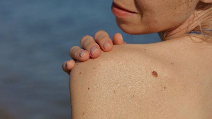  Florida legislators reject insurance coverage for skin cancer screenings