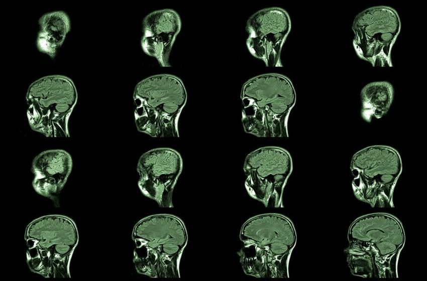  Cannabis derails train of thought, but may not affect long-term memory
