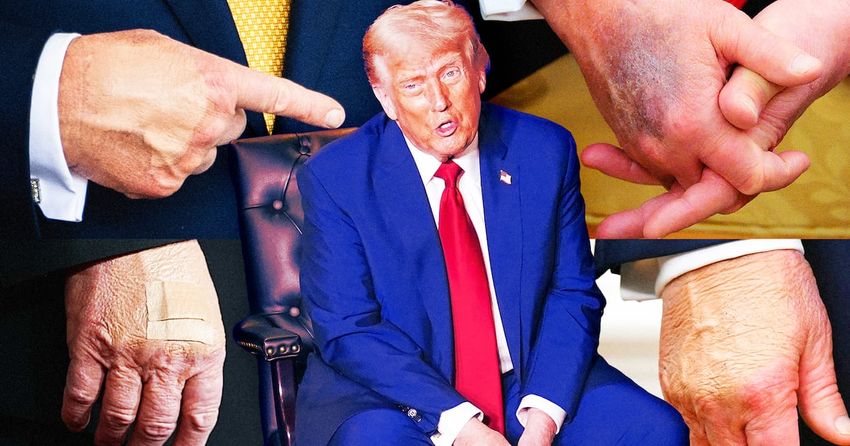  How Trump, 79, Turned Bruises and Cankles into Full-Scale Health Crisis