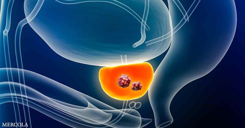  Study Finds Microplastics in Most Prostate Tumors